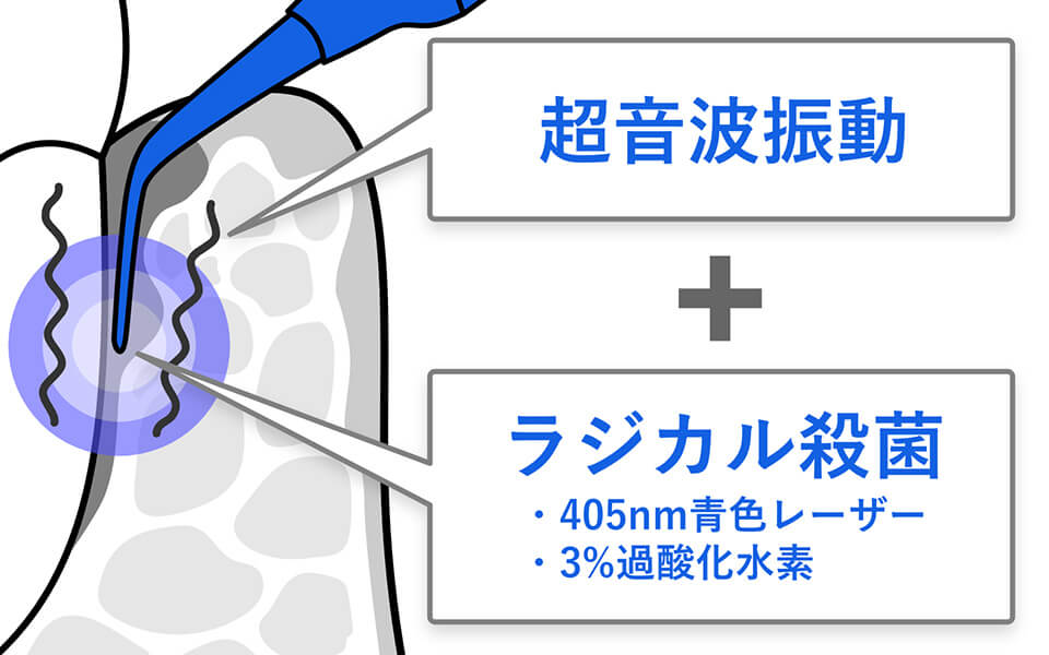 超音波振動 + ラジカル殺菌