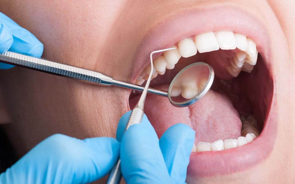虫歯の原因と治療のリスク