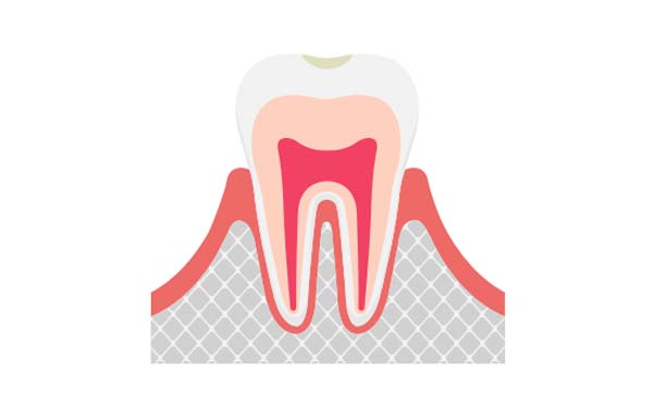 C0 初期の虫歯