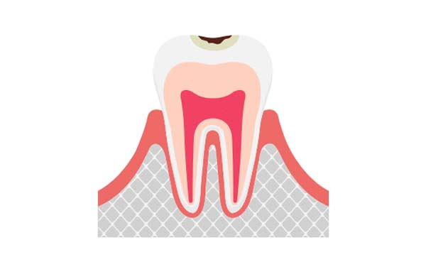 C1 エナメル質の虫歯