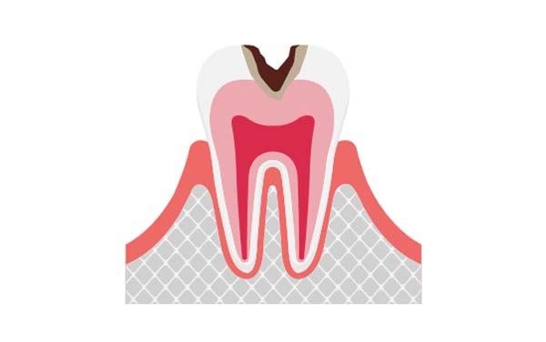 C2 象牙質の虫歯