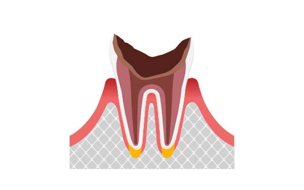 C4 歯根に達した虫歯
