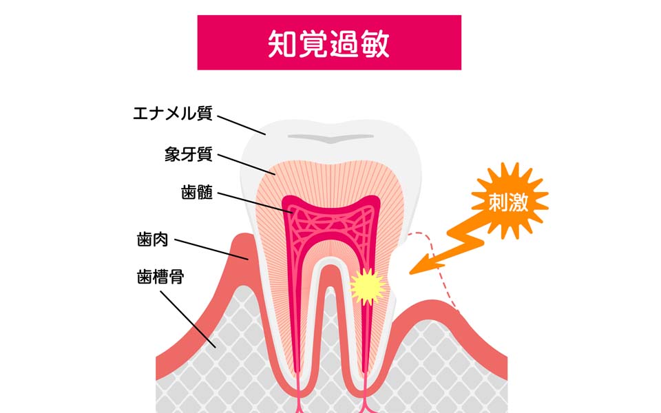 知覚過敏とは