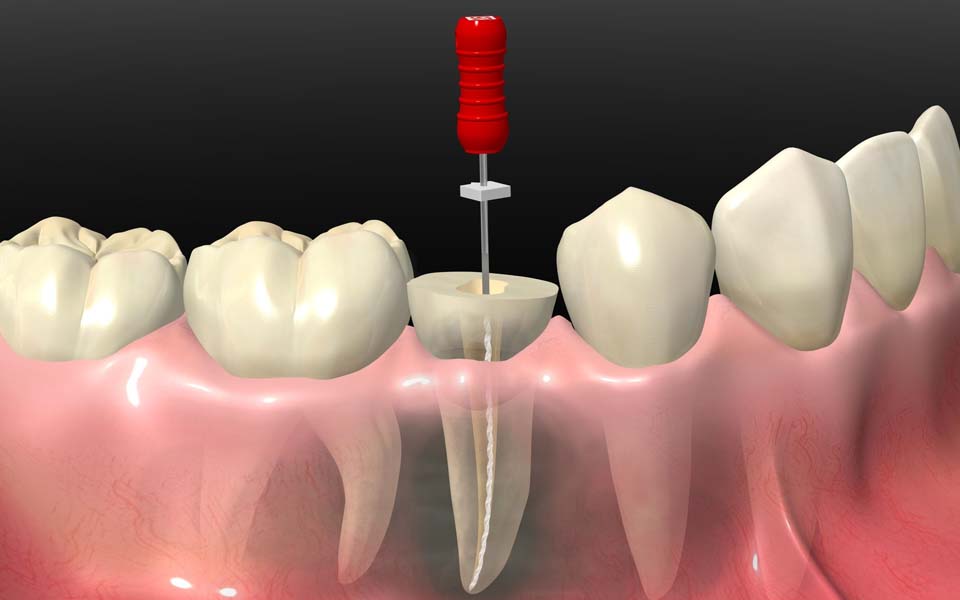根管治療とは