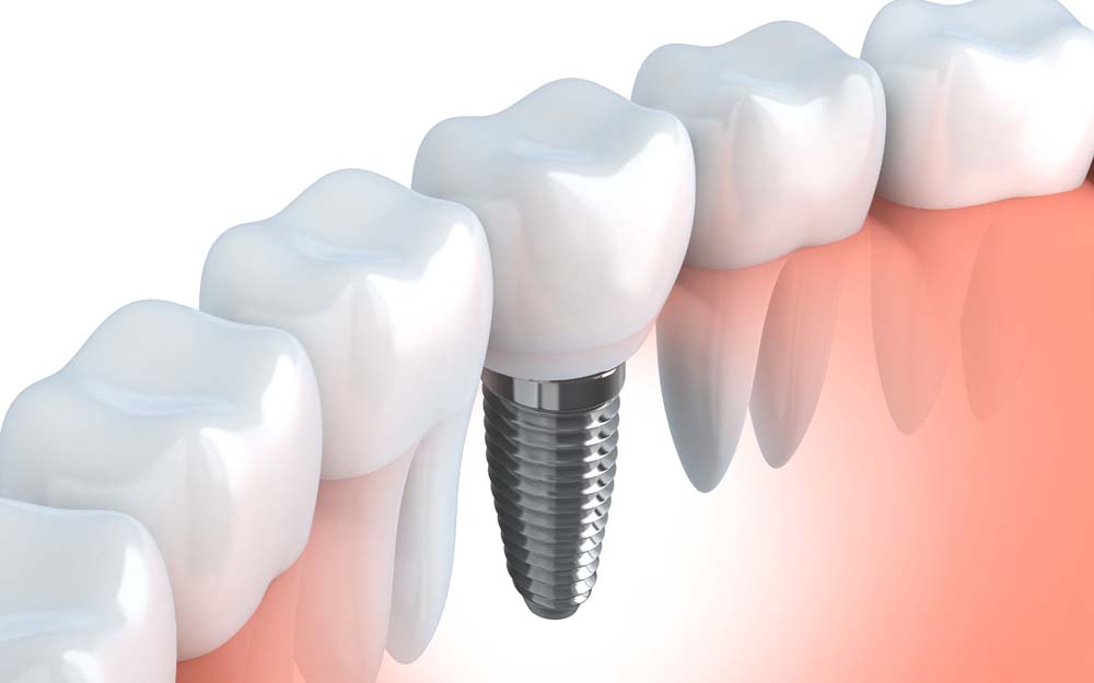 インプラントによる治療とは