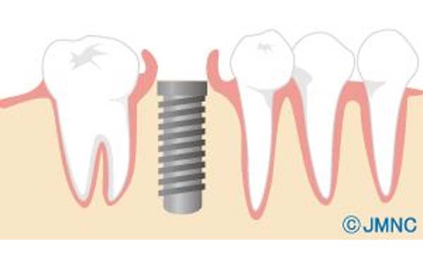 02.インプラント埋入