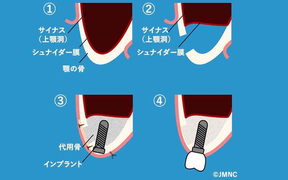 サイナスリフト