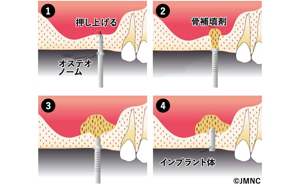 ソケットリフト