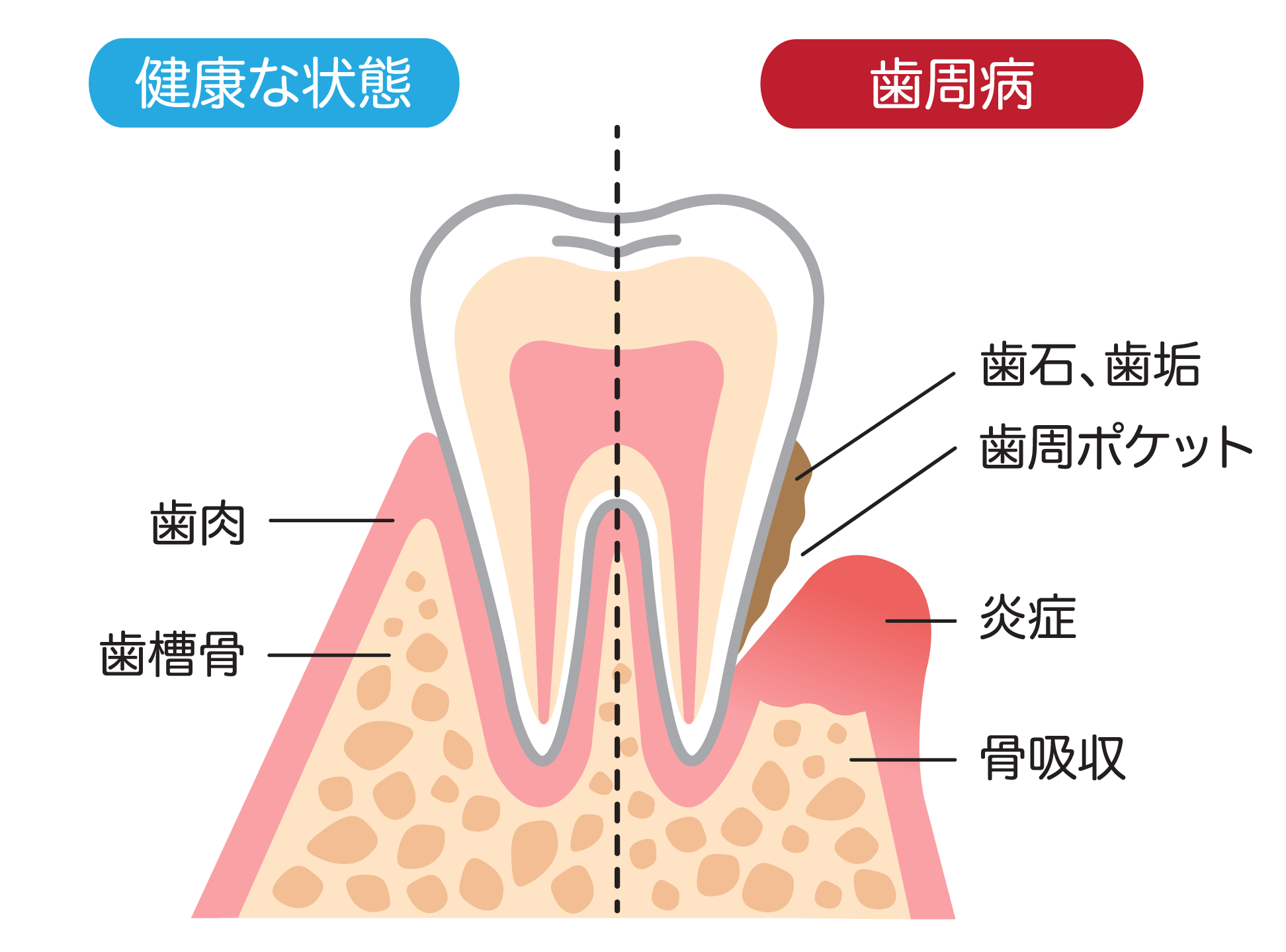 歯周病とは